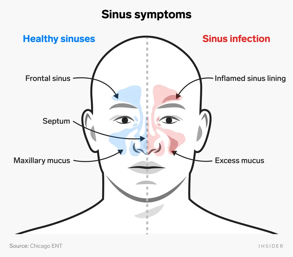 SINUS PRESSURE Rohini ENT Clinic